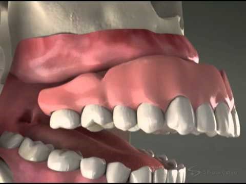 Avadent Digital Dentures Bill WY 82631